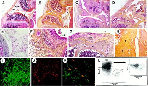 Autoimmune arthritis imaging