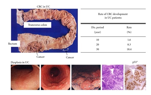 Colon cancer imaging